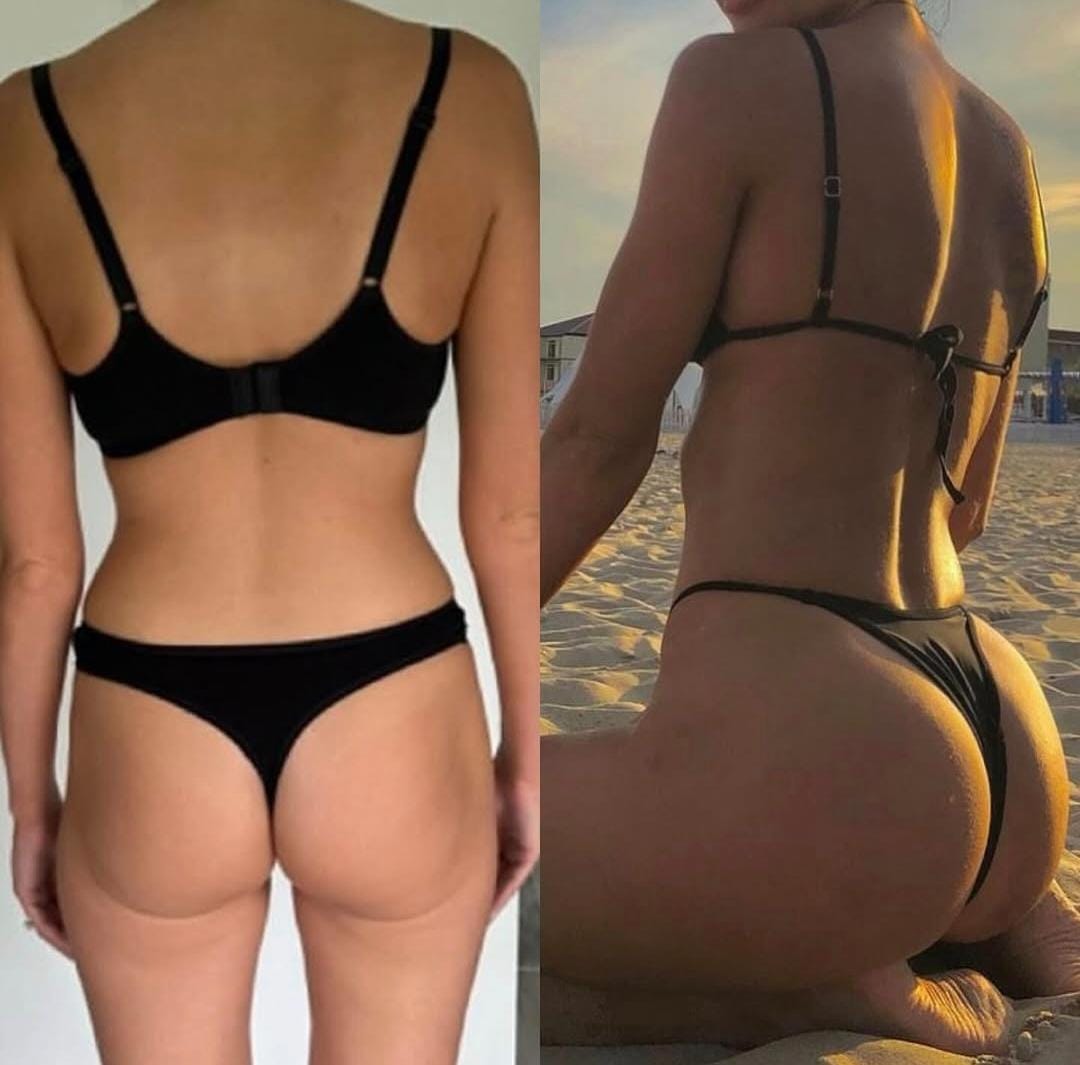 Brazilian Butt Lift (BBL)