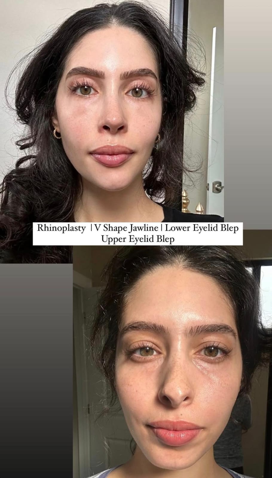 Blepharoplasty