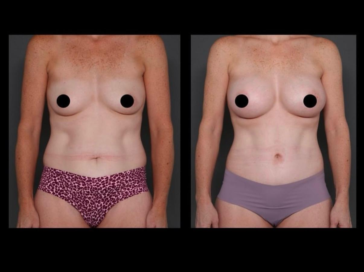 Breast Lift & Augmentation