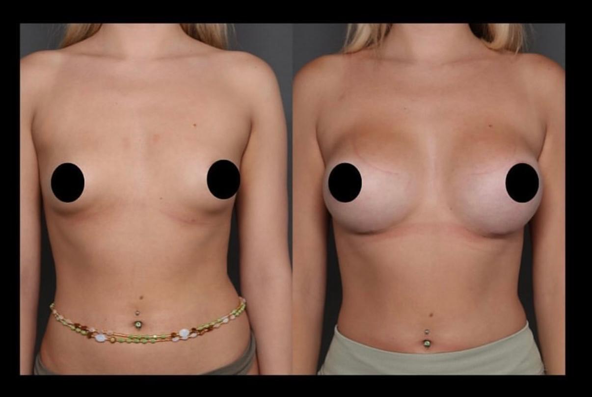 Breast Lift & Augmentation