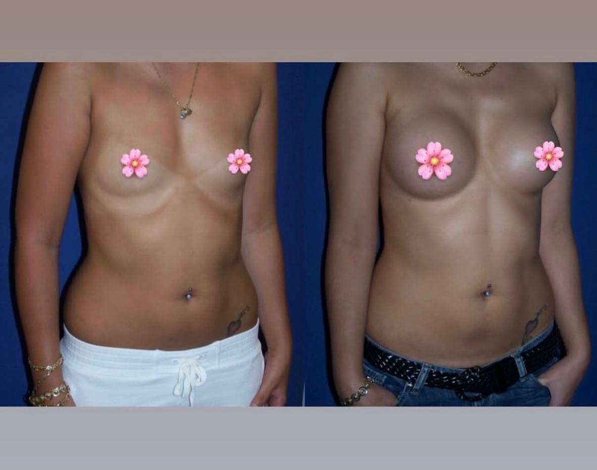 Breast Lift & Augmentation 3