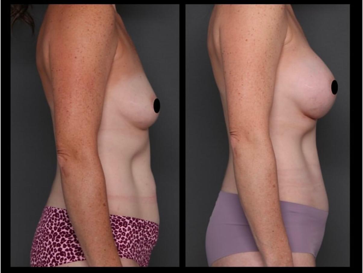 Breast Lift & Augmentation 4