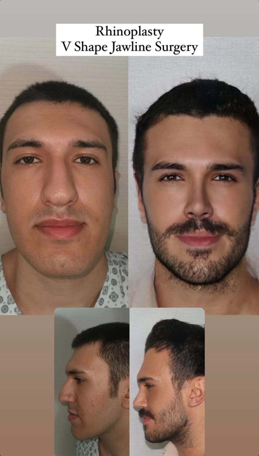Facial Implants 3