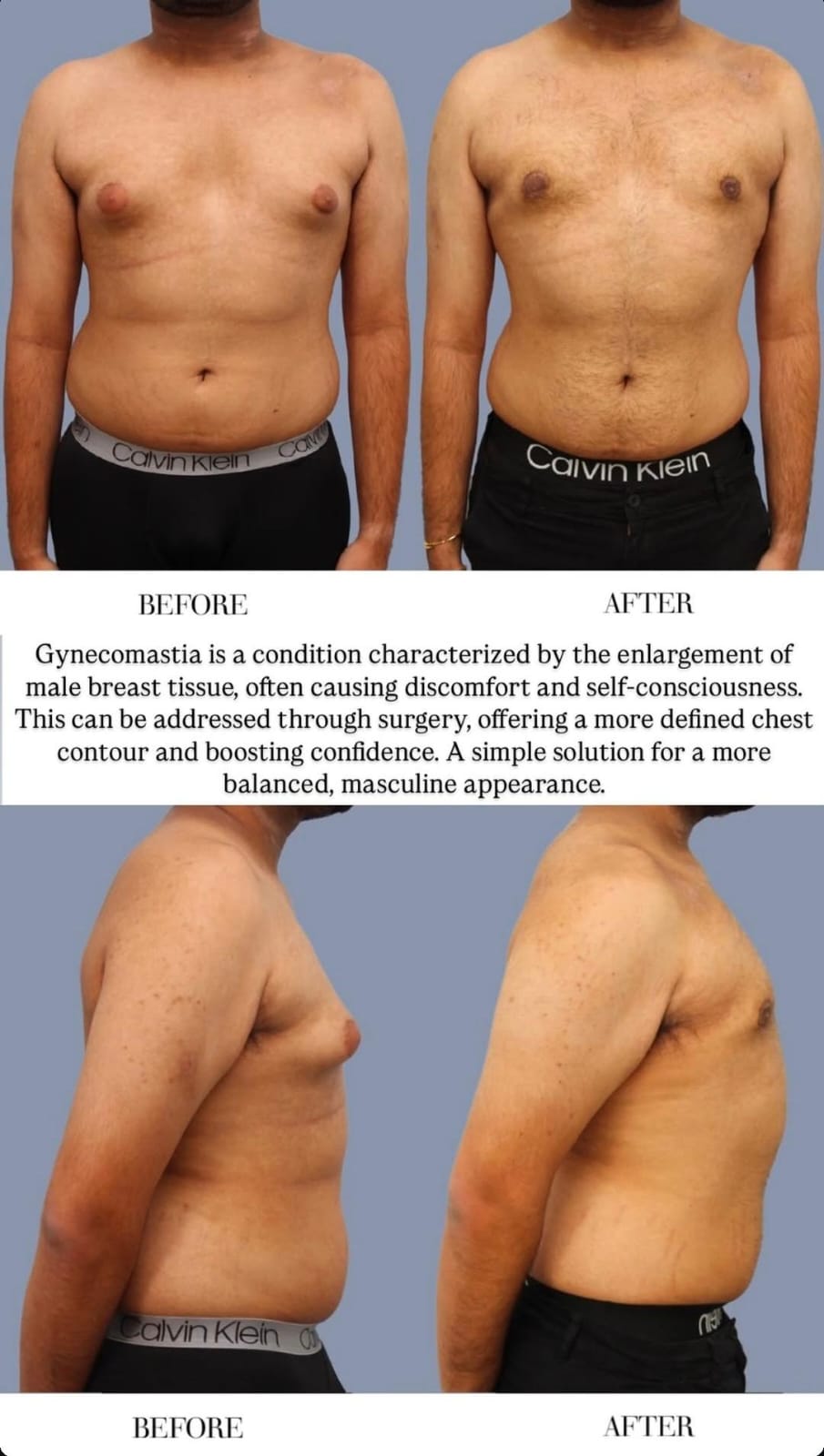 Gynecomastia Surgery