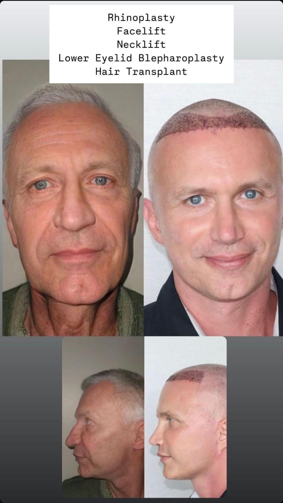 Hair Transplant