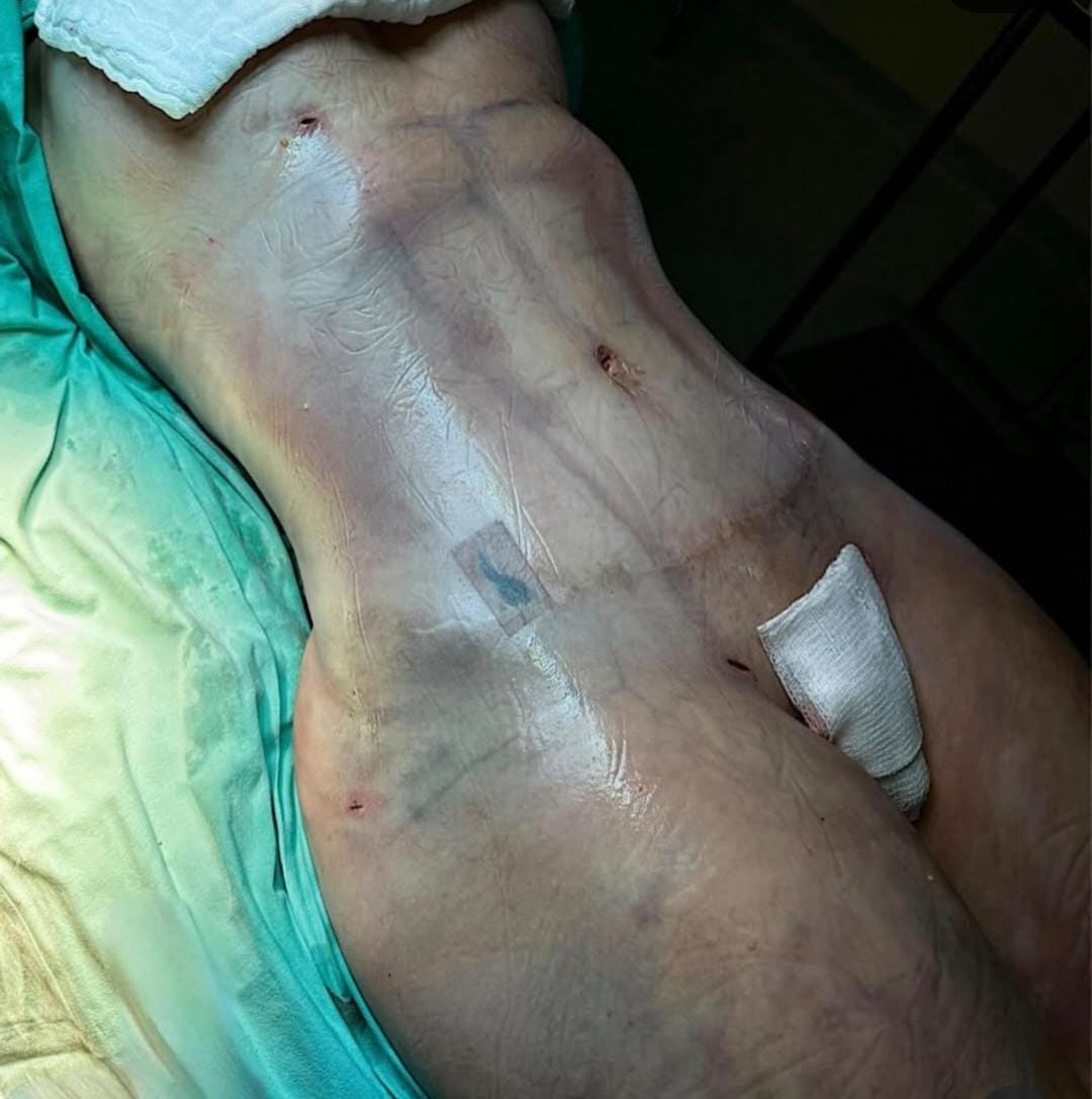 Liposuction & Vaser Hi-Def