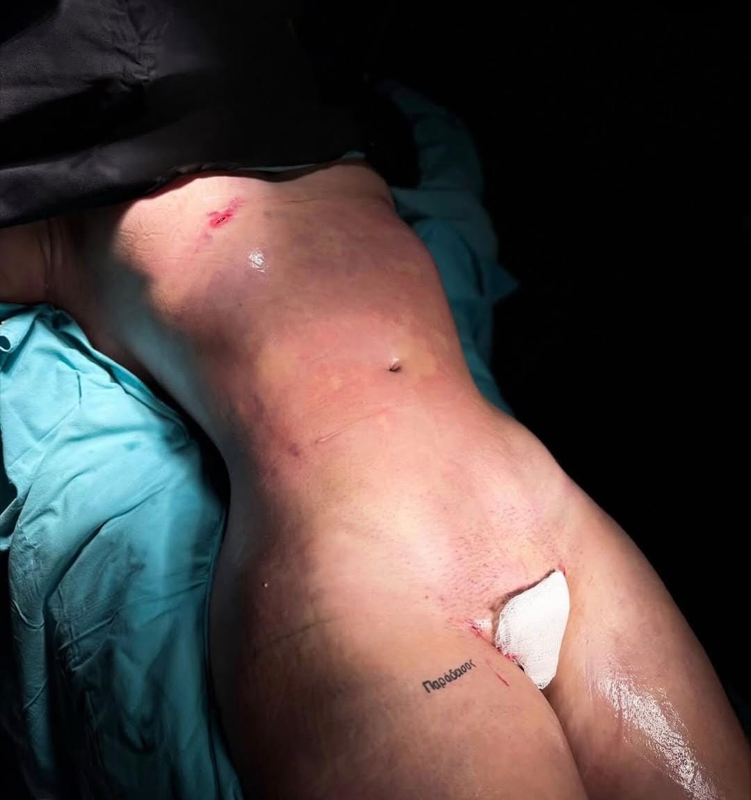 Liposuction & Vaser Hi-Def