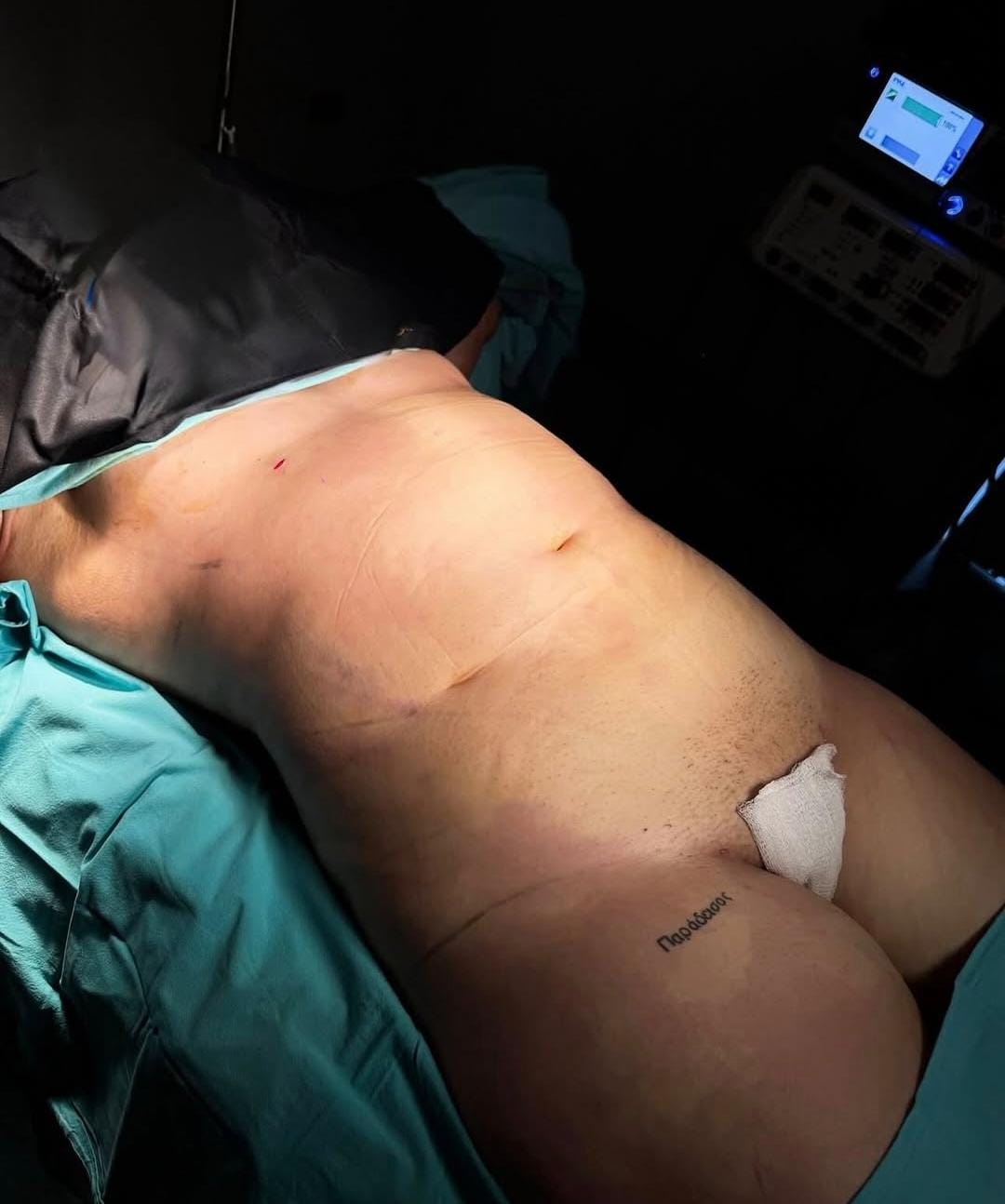 Liposuction & Vaser Hi-Def 3