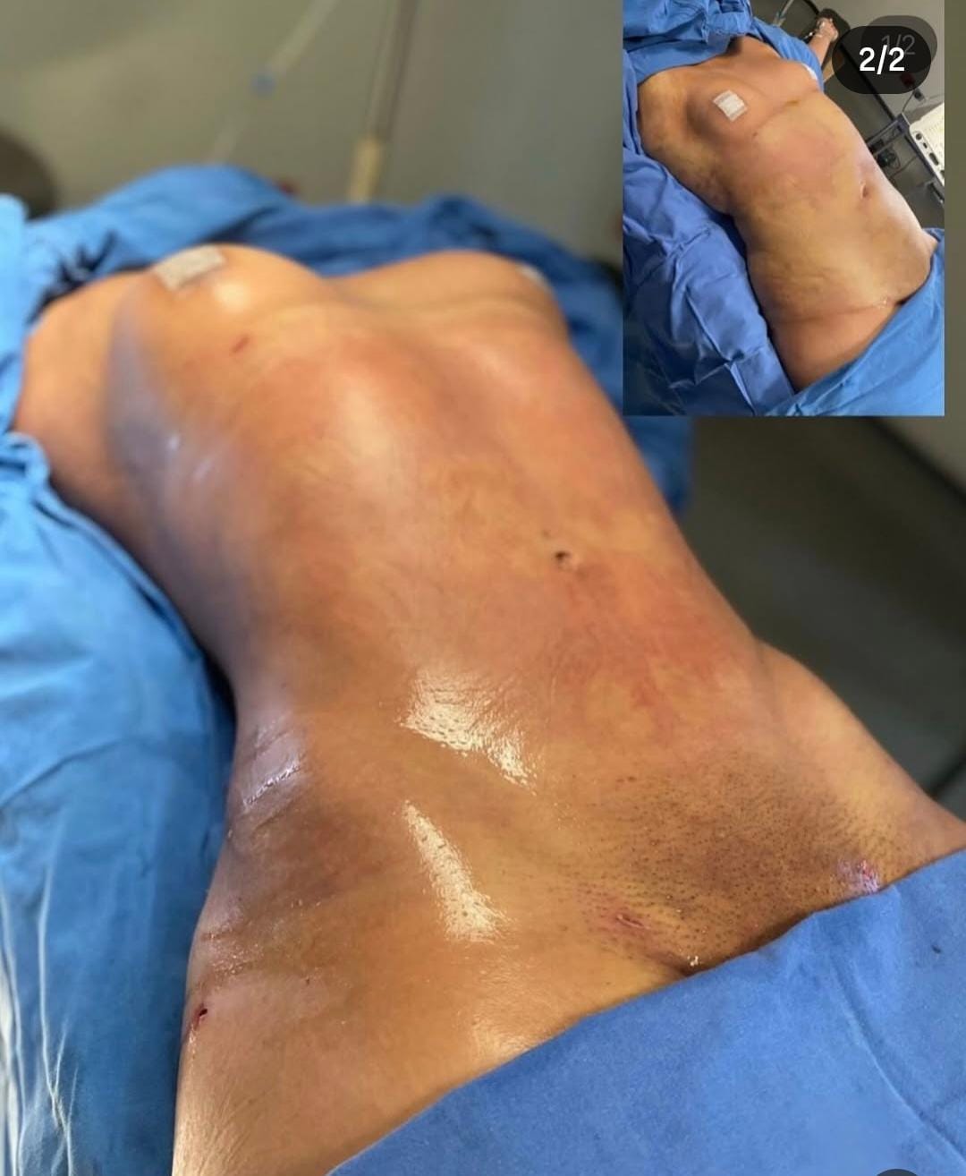 Liposuction & Vaser Hi-Def 4