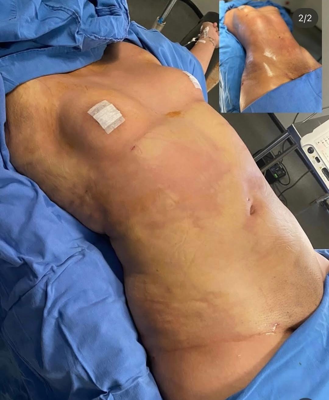 Liposuction & Vaser Hi-Def 5