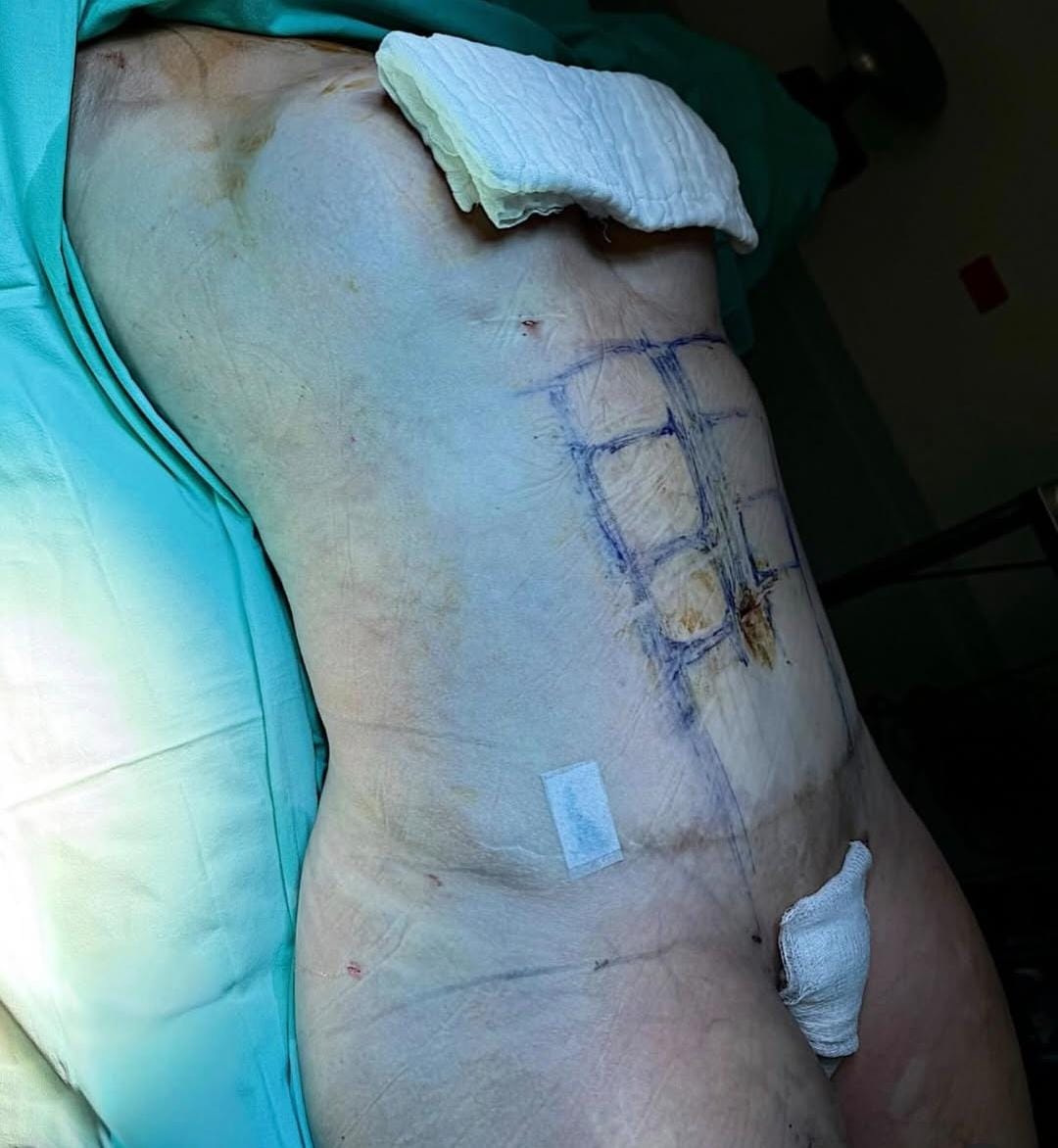 Liposuction & Vaser Hi-Def 6