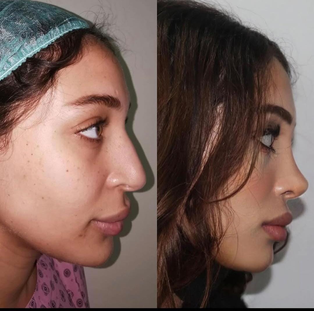 Rhinoplasty 3