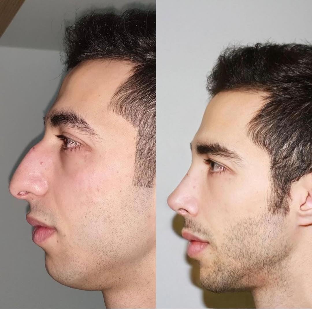 Rhinoplasty 4